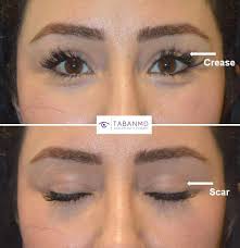Upper Blepharoplasty Beverly Hills