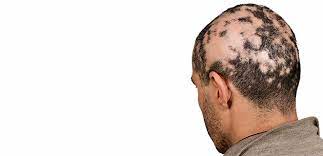 If your child has difficulty coping with the hair loss. Ø§Ù„Ø«Ø¹Ù„Ø¨Ø© Ø§Ù„Ø¨Ù‚Ø¹ÙŠØ© Ø§Ù„Ø£Ø¹Ø±Ø§Ø¶ ÙˆØ§Ù„Ø¹Ù„Ø§Ø¬ ÙˆØ·Ø±Ù‚ Ø§Ù„ØªØ¹Ø§ÙŠØ´ Ø§Ù„Ø·Ø¨ÙŠ