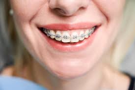 How Modern Orthodontics Has Enhanced Traditional Braces