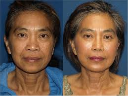 Asian Rhinoplasty San Diego Ethnic Rhinoplasty San Diego