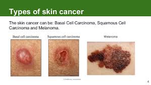 The ability to spread widely to other parts of the body is a unique characteristic of melanoma. Melanoma How To Detect Skin Cancer