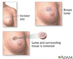 Image result for Breast Cancer