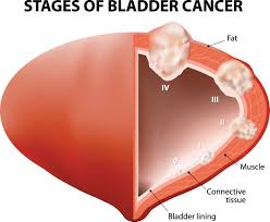 If you are concerned about any changes you experience, please talk with your doctor. Bladder Cancer