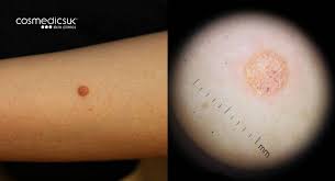 mole mapping and skin checks. Mole Clinic Mole Checks Screening Cosmedics Skin Clinics