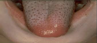 The signs and symptoms include a sore throat, fever, headaches, swollen lymph nodes, and a characteristic rash. Febbre Mal Di Gola E Arrossamenti Forse E Scarlattina Blogmamma It