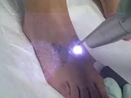 In laser tattoo removal will require several treatments. Tattoo Removal Removal Of Butterfly Tattoo On Foot At Dr Tattoff Laser Tattoo Removal Clinic Youtube