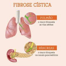La fibrosis quística es un trastorno heredado que causa daños graves en los pulmones, el sistema digestivo y otros órganos del cuerpo. Fibrose Cistica Exige Dieta Especial Nupad