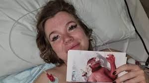 My son was born with 2 percent of his brain