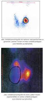 images Struma Nodosa Schilddrüse
