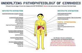 Underlying Pathophysiology Of Cirrhosis Medical Humor Nursing School Studying Nursing School Humor