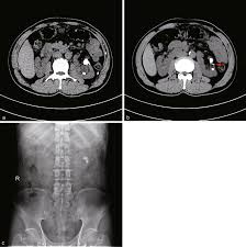 Image result for Nephrolithiasis Imaging