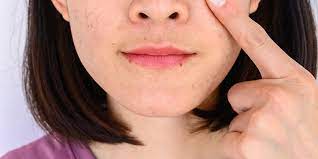 Jika kulit bibir terkelupas, jangan dikelupas dengan tangan. 6 Penyebab Kulit Wajah Mengelupas Dan Cara Mengatasinya