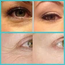 Pin By Sabien On Anti Aging Sun Damage Acne And Sensitive Skin Rodan And Fields Rodan Fields Skin Care Rodan And Fields Redefine