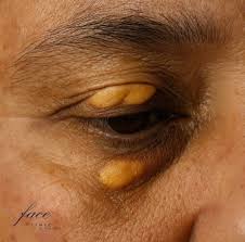 Image result for xantelasma