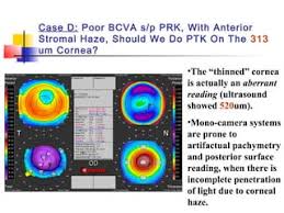 Clearing Up Corneal Haze | Corneal Physician