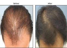 The 'most effective' remedy to boost hair growth latest hair loss treatment: Carboxytherapy For Hair Loss London Dr Sw Clinics