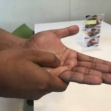 Kolesterol tinggi ini bisa menyebabkan timbunan lemak, yang bisa menghambat aliran darah di dalam tubuh. Tanda Tanda Kolesterol Tinggi Photos Facebook
