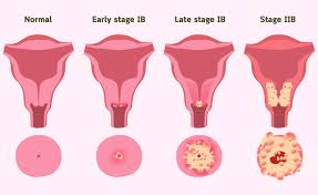 Cervical cancer rarely causes symptoms in early stages. Cervical Cancer Causes Symptoms Treatment Parkway East Hospital