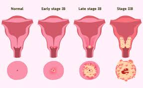 Especially when the cancer is just at its beginning stage. Cervical Cancer Causes Symptoms Treatment Parkway East Hospital
