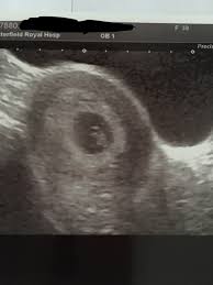 Pregnancy > week by week. 7 Weeks Light Pink Spotting And Period Pains