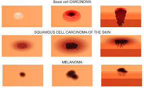 Here we look at some of the key symptoms of this disease to watch out for. What Are Skin Cancers Of The Feet Hamilton Foot Care