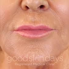 Juvéderm Volite in Leeds and Bradford - Good Skin Days