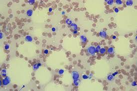 Bone marrow aspiration and biopsy are usually done together. Mutations In Donors Stem Cells May Cause Problems For Cancer Patients Washington University School Of Medicine In St Louis