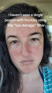 I love my thousands of little sun damages ✨️ #sundamage #freckles  #noirfilter #sundamagefilter #fyp