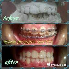 Jenis gigi untuk pakai braces. Klinik Pergigian Syarifah Nak Pakai Braces