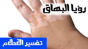 4 البهاق فى حلم الحامل. ØªÙØ³ÙØ± Ø±Ø¤ÙØ© Ø§ÙØ¨ÙØ§Ù Ø£Ù Ø§ÙØ¨Ø±Øµ ÙÙ Ø§ÙØ­ÙÙ ÙØ¬ÙØ© Ø±Ø¬ÙÙ