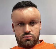 A man from Lancashire is urging people to ensure they always do a patch  test when using hair dye