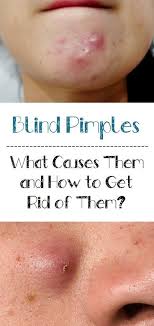 Pimples generally occur on the face, neck, back and shoulders and though it is not a critical condition, it can make a person feel miserable due to their appearance. Blind Pimples What Causes Them And How To Get Rid Of Them Skincareforacne Blind Pimple Hard Pimple Under Skin Pimples