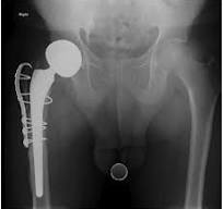 Greater Trochanteric Fixation Using Cable Plate Devices in ...
