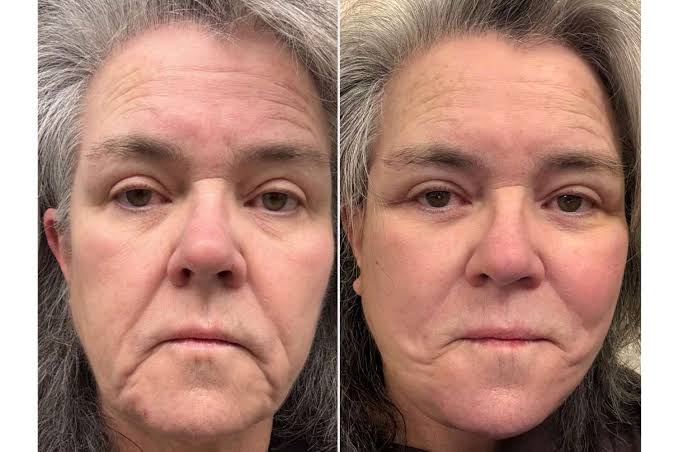 Rosie O'Donnell, 64, Shares Unfiltered Before-and-After Facelift Photos