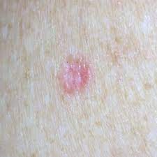 Specks of brown and grey pigment. Basal Cell Carcinoma Pictures Skinvision