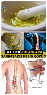 Bel Fitigi Icin Dogal Tedavi Yontemi Health Natural Health Remedies Health Doctors