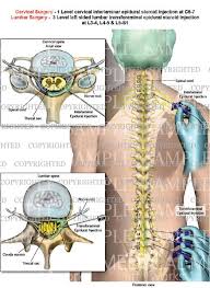 Pin On Epidural Steroid Injection