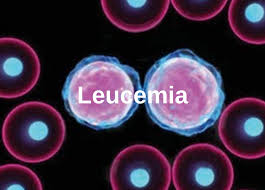 Semne si simptome ale leucemiei mieloide acute 3. Leucemia Ce Este Leucemia Cauzele Leucemiei Remedii Naturiste