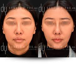 Beverly Hills Facial Plastic Surgery