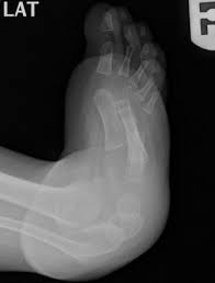 Thickening of the tendon sheaths frequently is present, especially of the tibialis posterior and peroneal sheaths. Clubfoot Congenital Talipes Equinovarus Pediatrics Orthobullets
