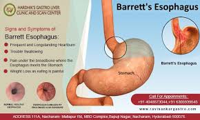 Barrett S Esophagus Symptoms Barretts Esophagus Heartburn Relief Instant Heartburn Relief