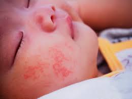 Die ringelröteln sind eine seltene, leicht ansteckende viruserkrankung. Ringelroteln In Der Schwangerschaft Bei Erwachsenen Und Kindern Wunderweib