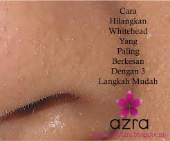 Lantas, bagaimana cara menghilangkan jerawat whitehead? Beauty By Azra Cara Hilangkan Whitehead Yang Paling Berkesan Dengan 3 Langkah Mudah