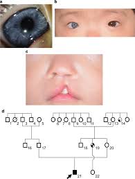 A Novel Pax3 Mutation In A Japanese Boy With Waardenburg Syndrome Type 1 Human Genome Variation