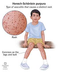 Image result for Vasculitis
