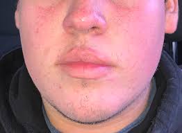 Make sure to keep the air inside your home and in your workspace moisturized with a humidifier. Worst Rosacea Flare Up I Ve Had Ever I Want To Cry Rosacea