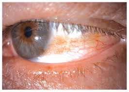 Image result for conjunctival melanoma