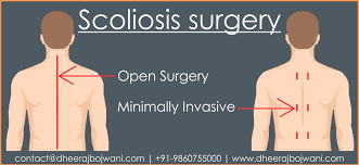 Get More Information About Affordable Scoliosis Surgery Scoliosis Surgery Scoliosis Surgery