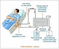 Person With A Kidney Failure Objectives Learn More About Dialysis And Complete Range Of Dialysis Treatments And Suppo Kidney Dialysis Dialysis Kidney Failure