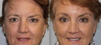 Facial Plastic Surgeon Orange County